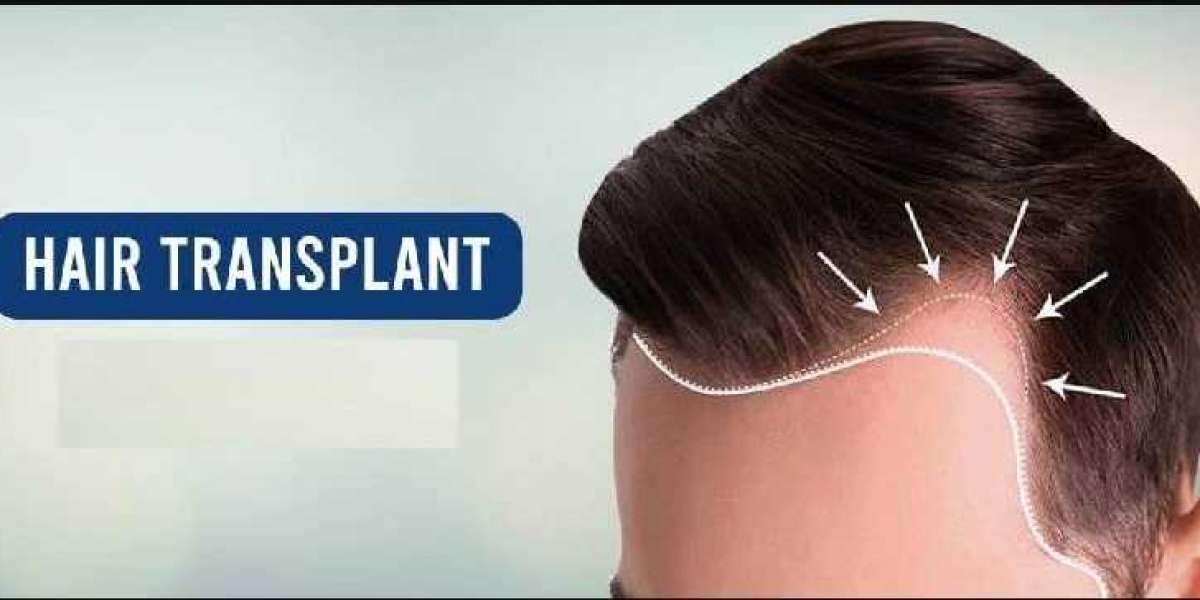The Ultimate Guide to Hair Transplant in Raipur: What to Expect