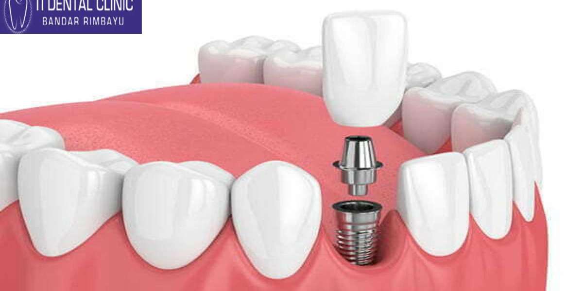 Smile Restoration: The Transformative Impact of Dental Implants